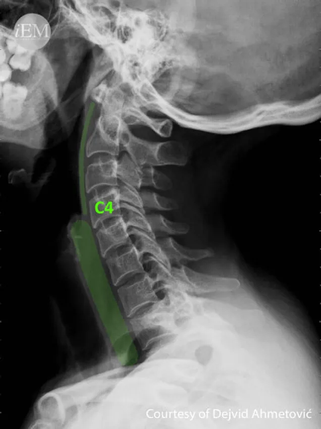 X-ray Cervical Spine AP & Lateral