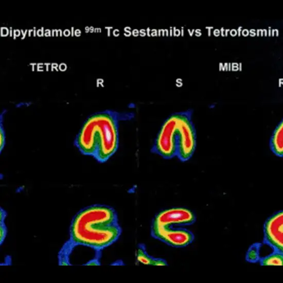 sestamibi/tetrofosmin stress myocardial