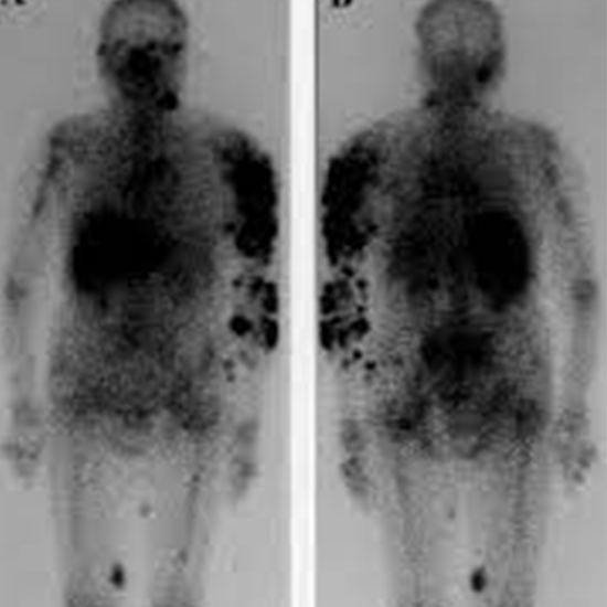 Gallium Whole Body Scan | Test Price In Delhi | Cost Near Me, India ...