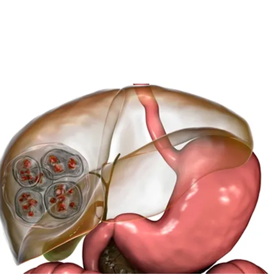 anti echinococcus igg (hydatid serology)