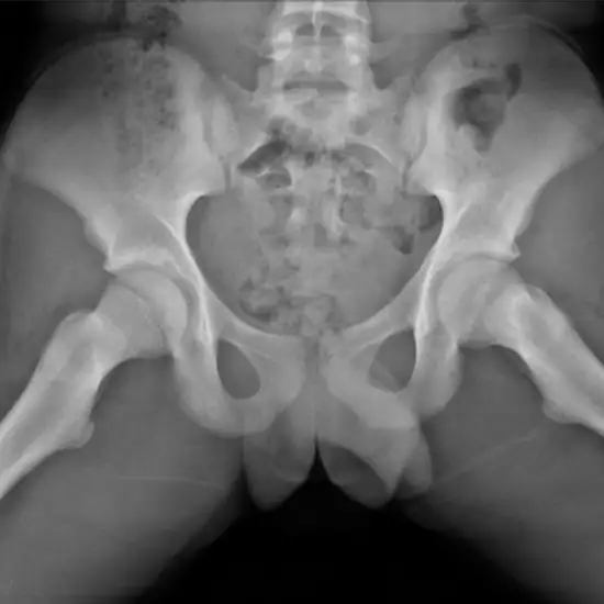 Both Hip X-ray (Frog View)