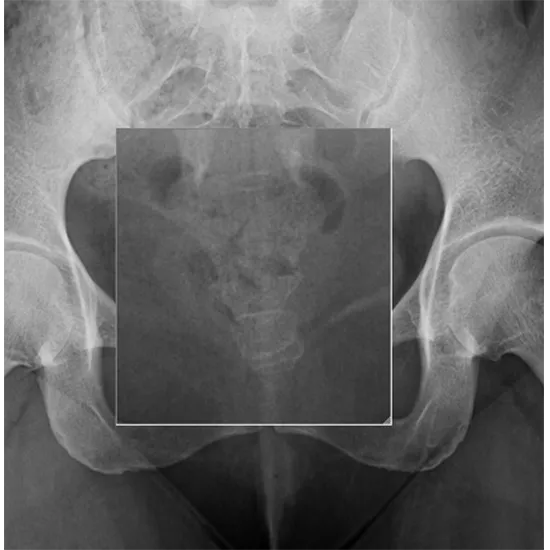 X-ray COCCYX AP/Lateral