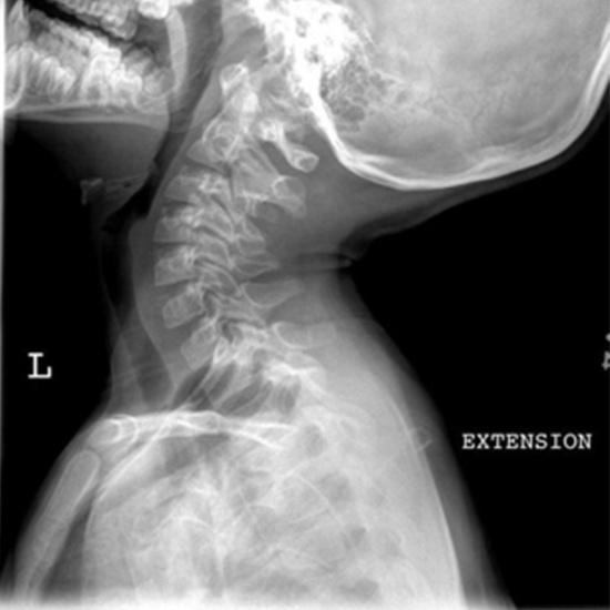 X-ray CV Junction Extension/Flexion