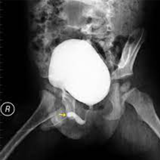 X-ray Cysto-Urethrogram