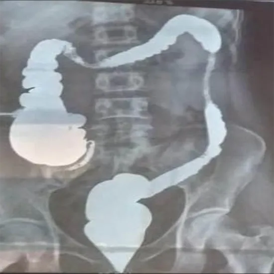 X-ray Distal Loop Cholangi
