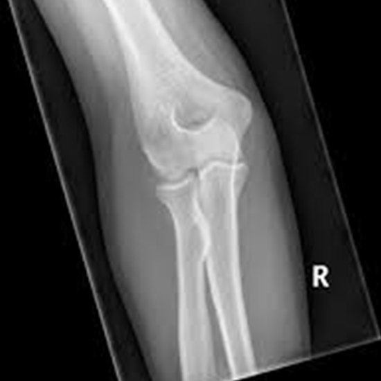 X-ray Elbow AP