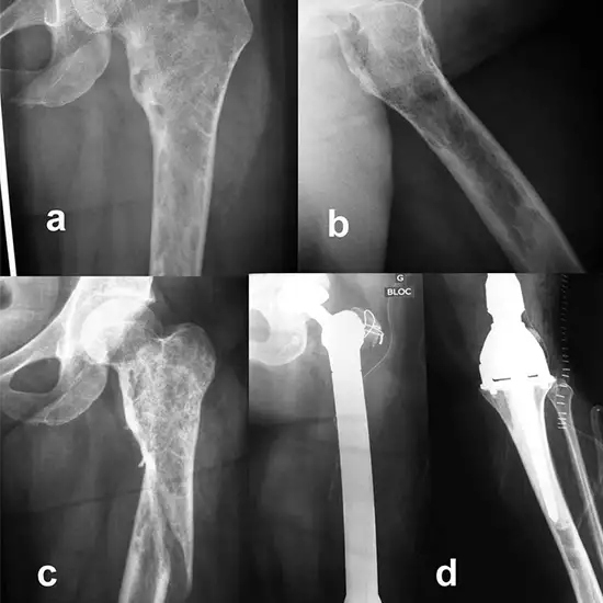 X-ray Hip Joint AP/Lateral