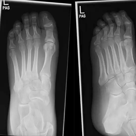 X-ray Foot AP View
