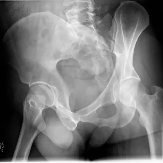 x-ray hip oblique