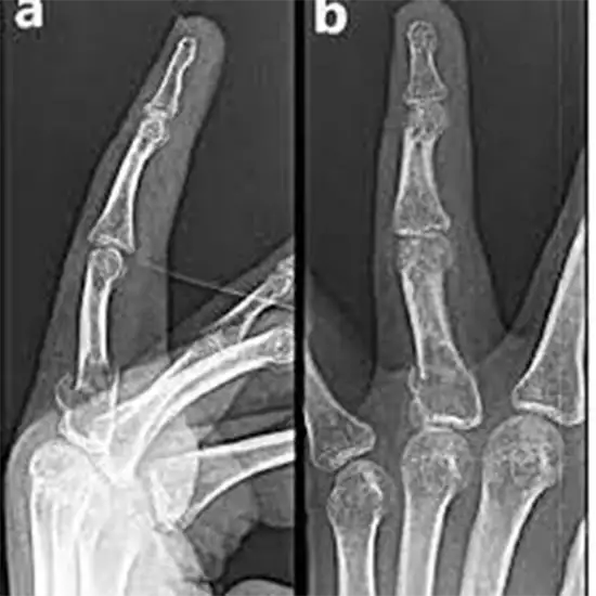 x-ray left finger ap/lateral
