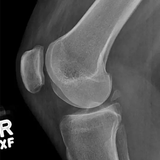 X-ray Left Knee Lateral View
