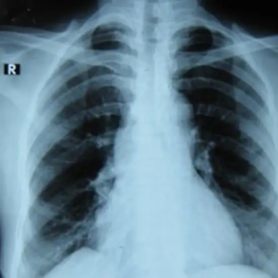 x-ray pft pulmonary function test