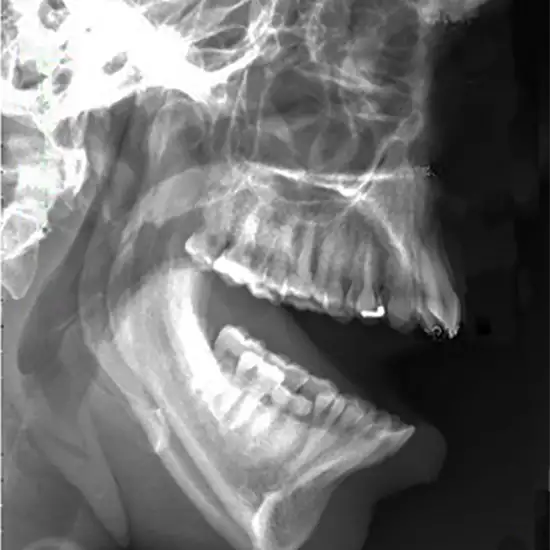 X-ray TM Joint-Open Mouth