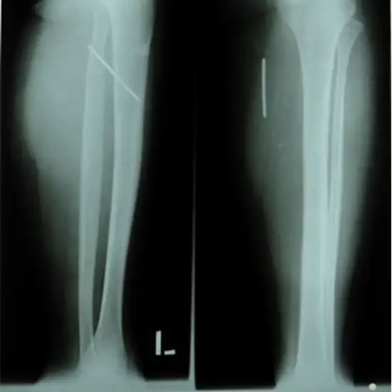 Both Leg X-ray LAT View