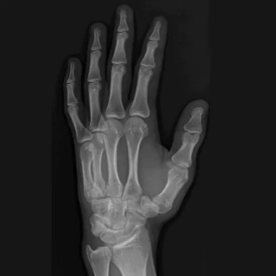 X-ray Mandible PA & Both Lat/Oblique