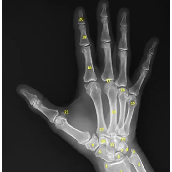 X-ray Left Index Finger AP/LAT