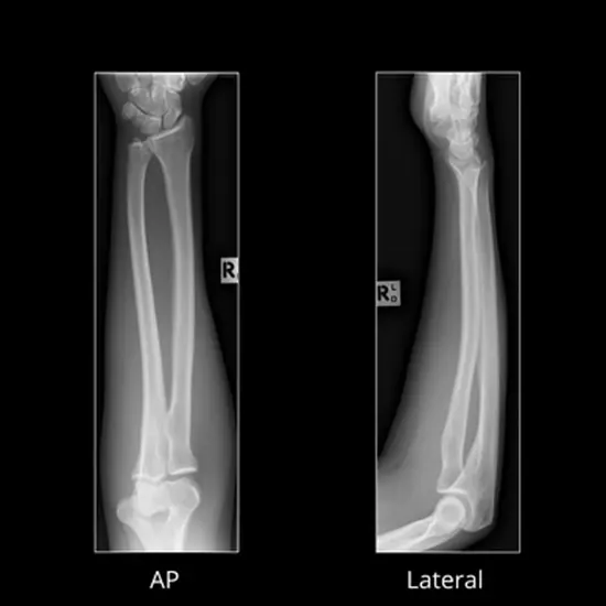 X-ray Right Arm AP & LAT