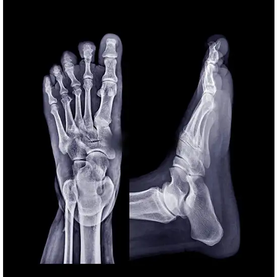 Right Foot X-ray AP LAT View