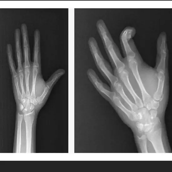 X-ray Right Calcaneum AP-Axial