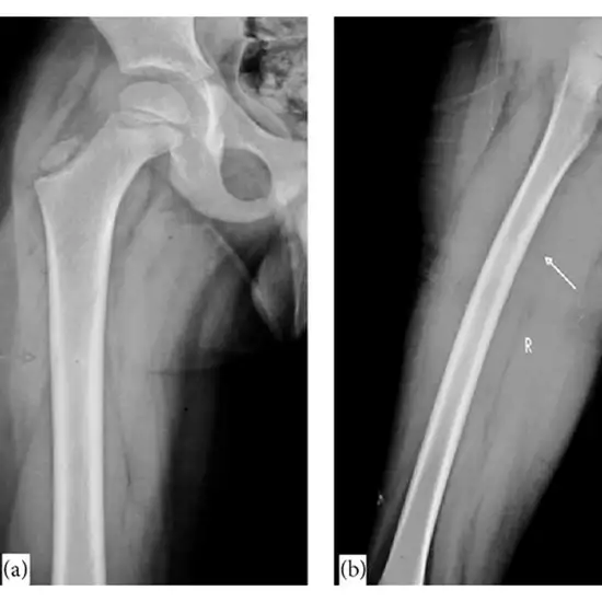 X-ray Right Femur AP & LAT View