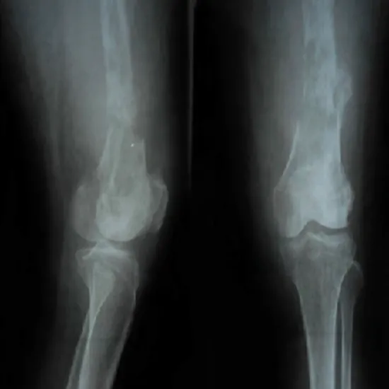 x-ray right femur thigh ap and lat view