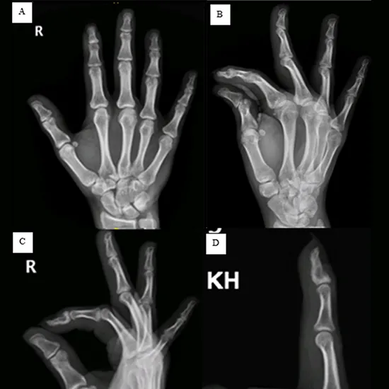 X-ray Right Finger AP LAT