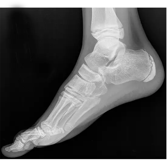 X-ray Right Foot LAT View