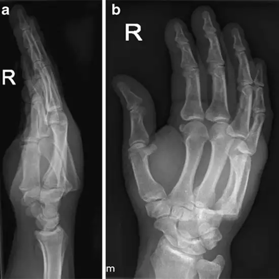 X-ray Right Hand AP & Oblique