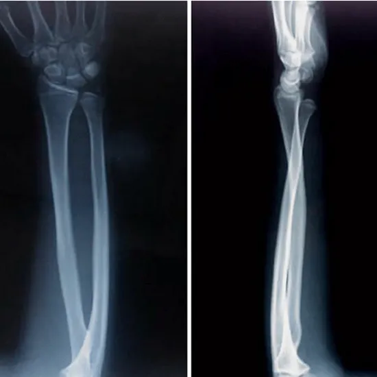 x-ray right forearm ap lat view