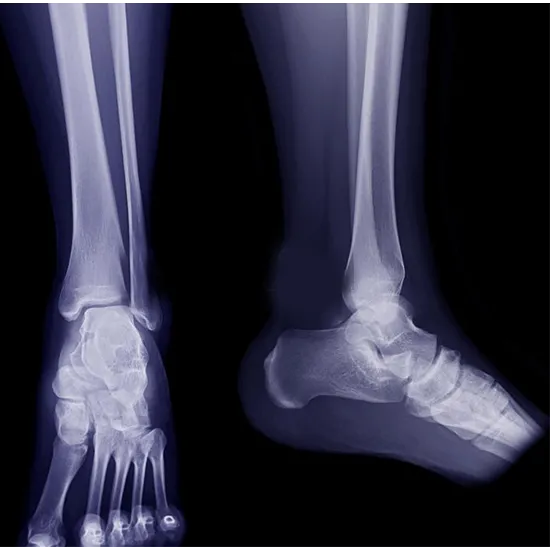 X-ray Right Heel AP & LAT View