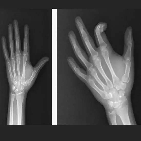 X-ray Right Thumb AP & LAT