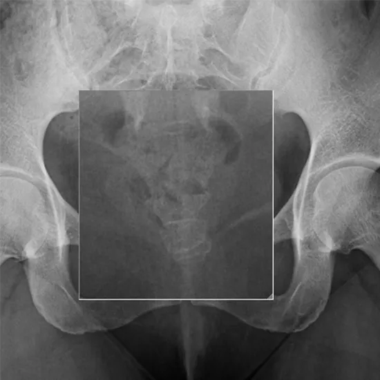 x-ray sacrum coccyx ap view