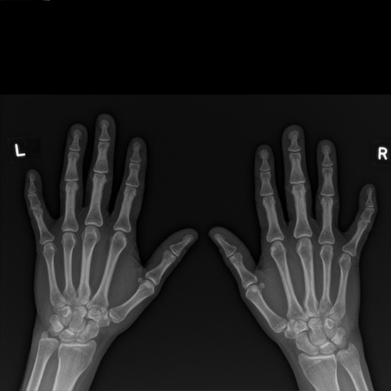 X-ray Both Hand AP & LAT