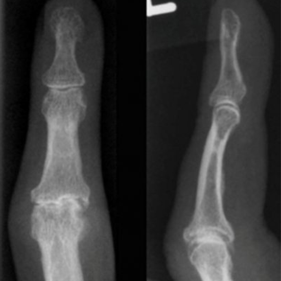 X-ray Left Finger AP & LAT