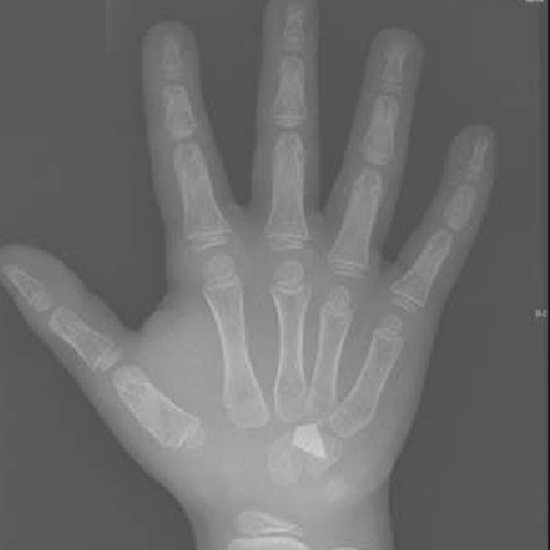 X-ray Left Hand AP View