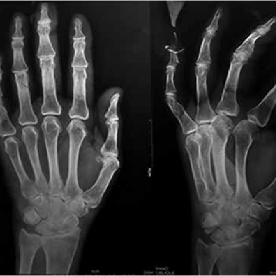 X-ray Left Hand AP & Oblique