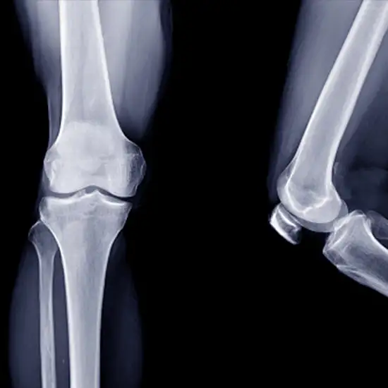 X-Ray Left Knee Joint AP & Lateral View