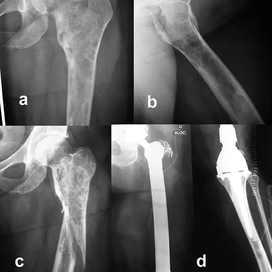 X-ray Left Hip Joint, Lateral View