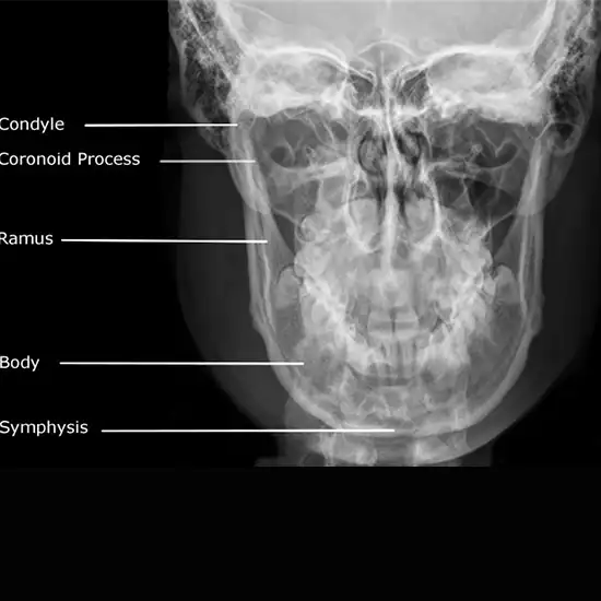 X-ray Left Mandible AP & Lateral
