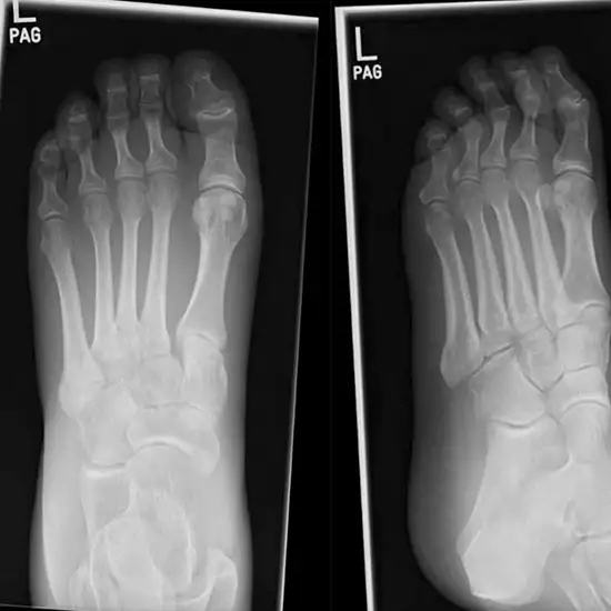 X-ray Right Feet AP/LAT