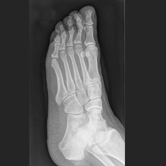 X-ray Right Foot AP/Oblique