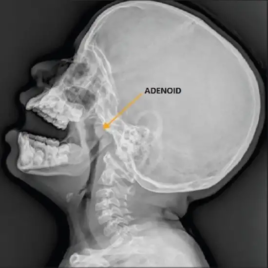X-ray Naso-Pharynx LAT View