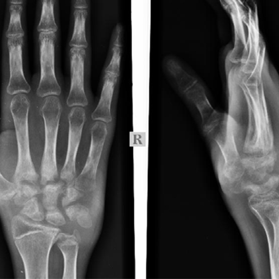 X-ray Right Hand AP/LAT