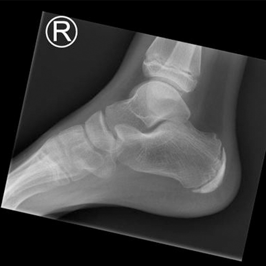 X-ray Right Heel AP/LAT