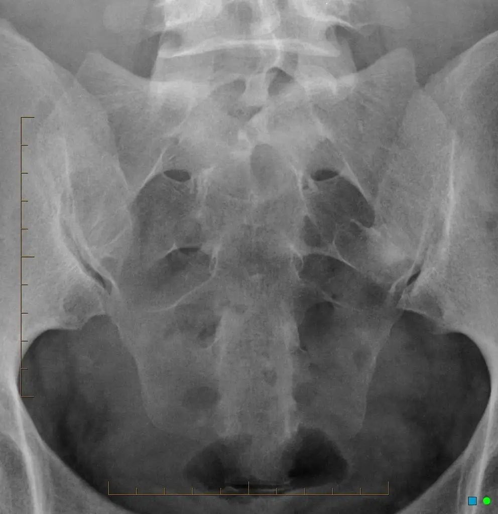 X-ray Sacro Coccygeal Spine