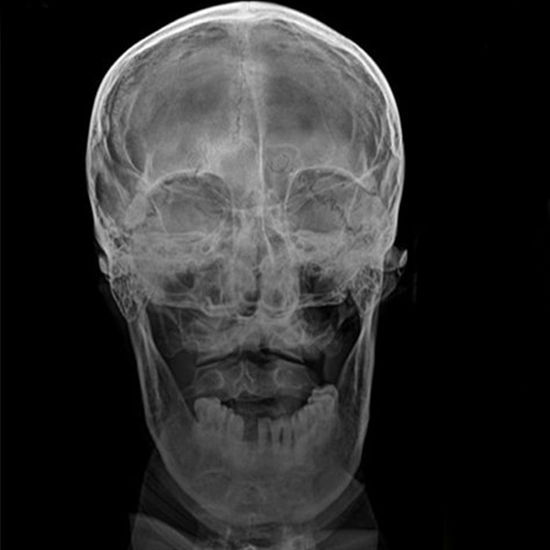 X-ray Skull AP And Lateral Views
