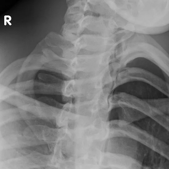 X-ray Sternoclavicular Joint Right View