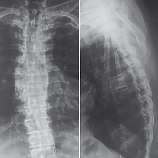 X-Ray Thoracic Lumbar (AP/LAT) View