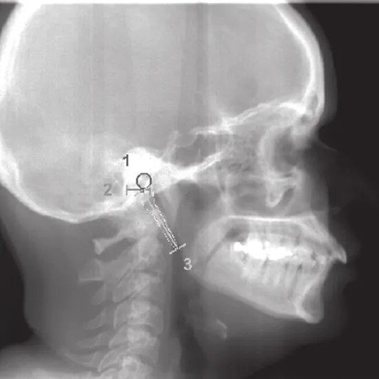 X-Ray Styloid Processes