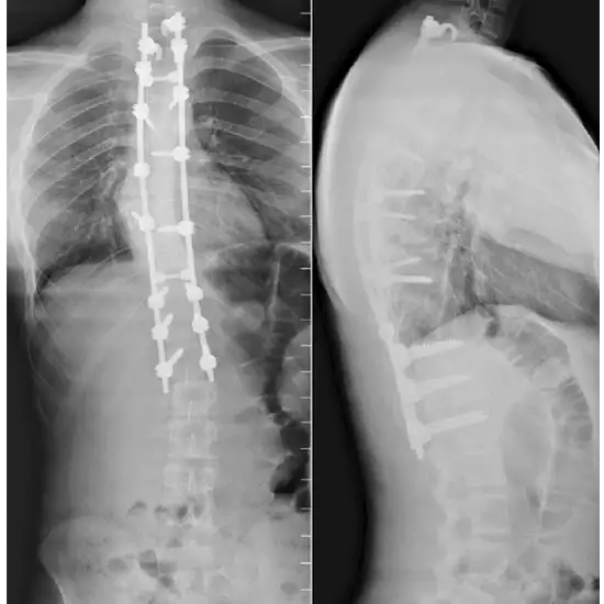 X-ray Whole Spine AP/LAT